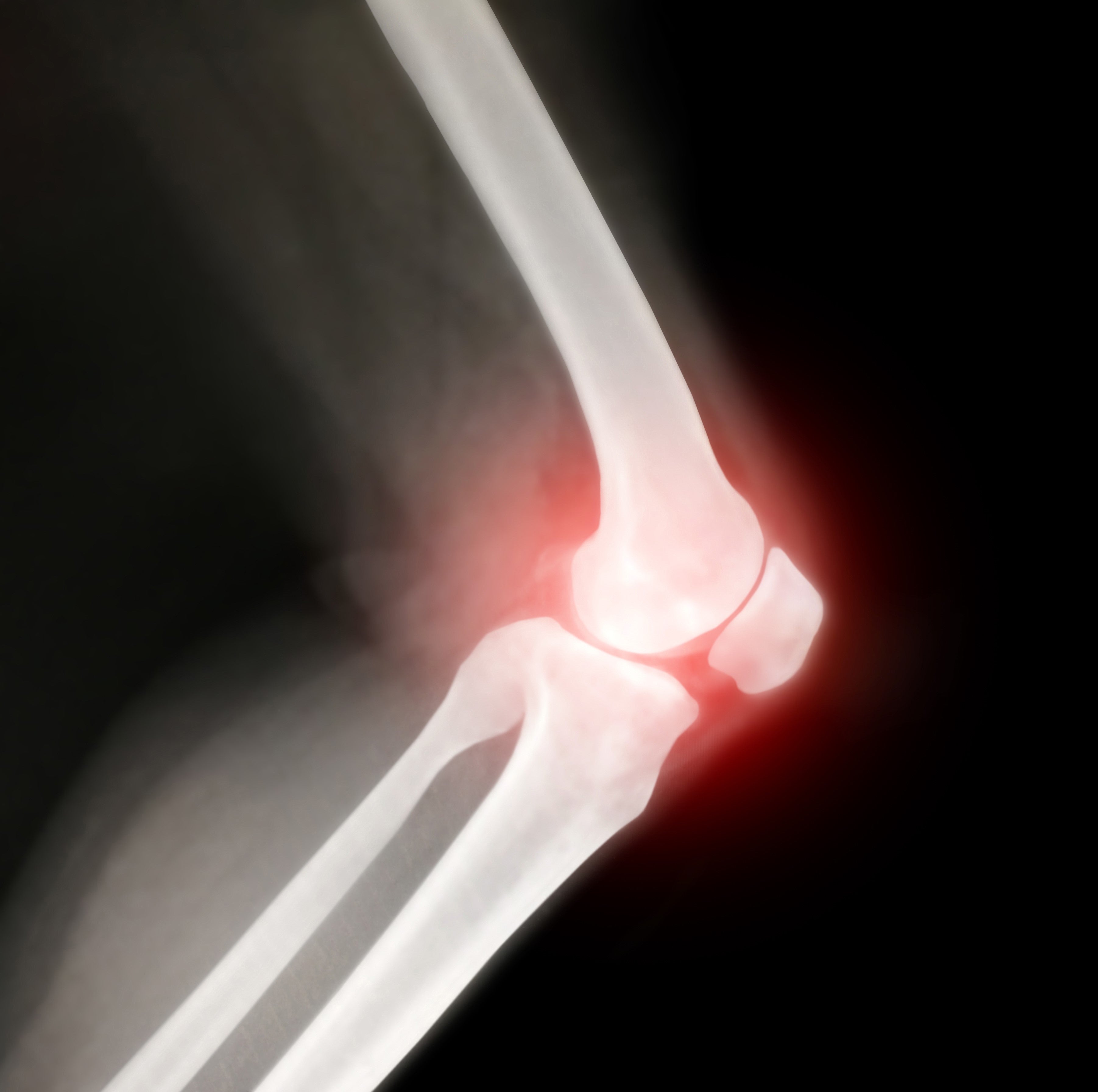 JOINT SUPPORTS FOR CHRONIC JOINT CONDITIONS: A COMPLETE GUIDE